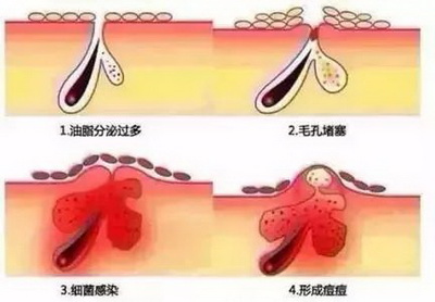 怎么才能好消除脸上的痘坑痘印